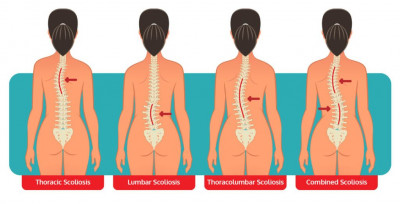 Types-Of-Scoliosis-1024x522.jpg